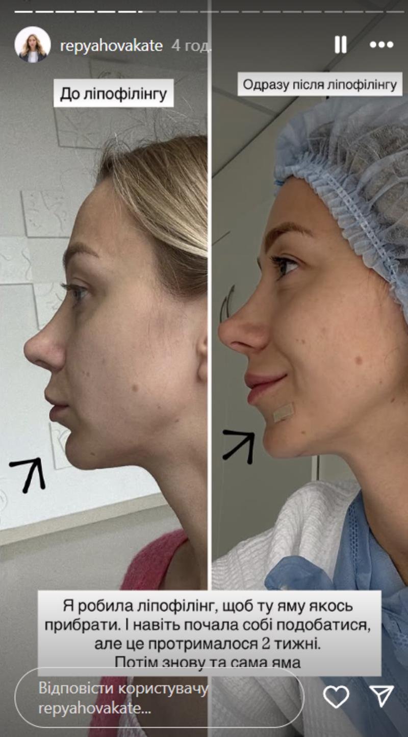 Репяхова поскаржилася на невдалу пластику