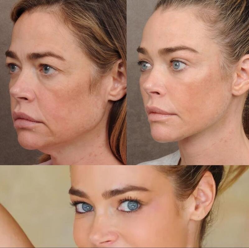 Деніз Річардс до та після підтяжки обличчя